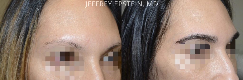 Eyebrow Hair Transplant Photos Miami Fl Patient36706