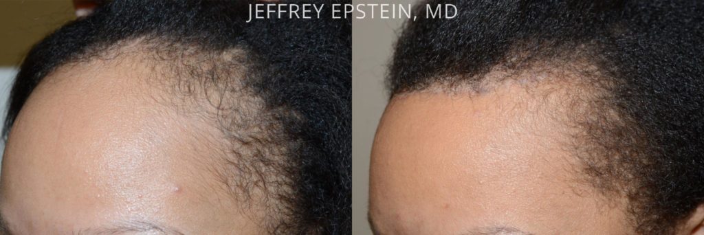 Forehead Reduction Surgery Photos | Miami, FL | Patient37362