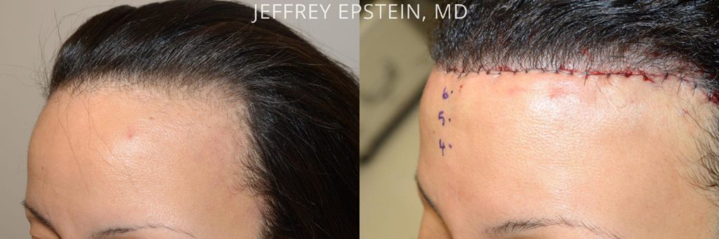 Forehead Reduction Surgery Photos | Miami, FL | Patient37385