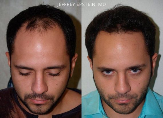 Trasplante de Pelo en Hombres Before and after in Miami, FL, Paciente 90594