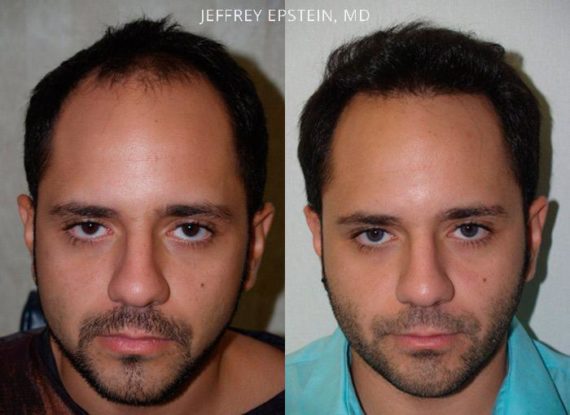 Trasplante de Pelo en Hombres Before and after in Miami, FL, Paciente 90594