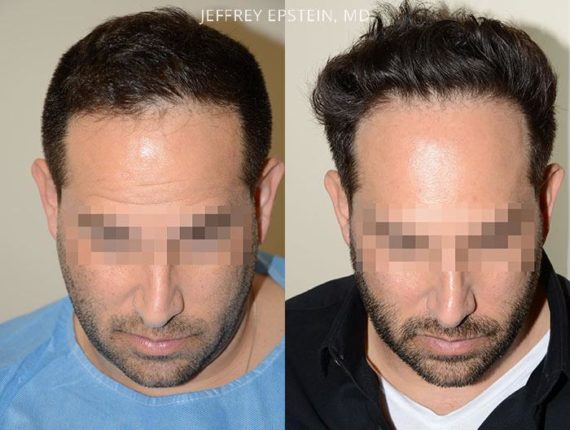 Trasplante de Pelo en Hombres Before and after in Miami, FL, Paciente 90438