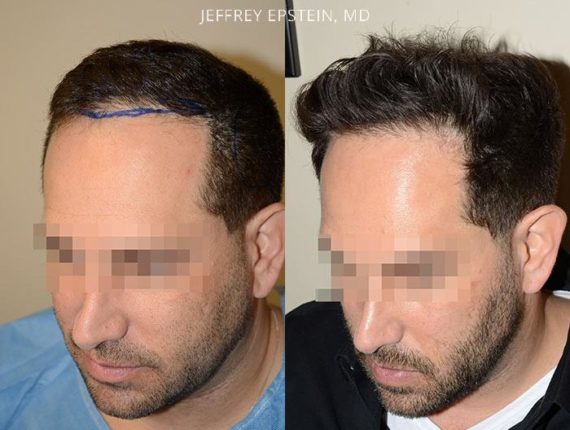 Hair Transplants For Men Photos Miami Fl Patient37541