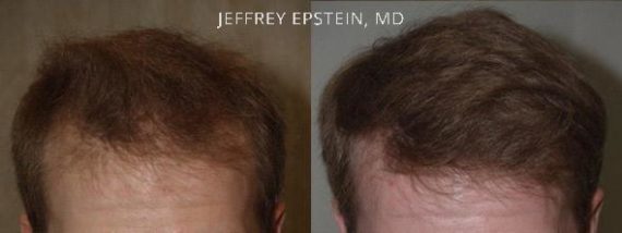 Trasplante de Pelo en Hombres Before and after in Miami, FL, Paciente 90360