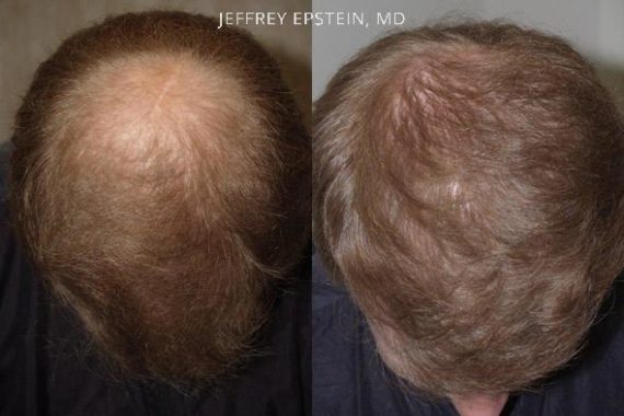 Trasplante de Pelo en Hombres Before and after in Miami, FL, Paciente 90360