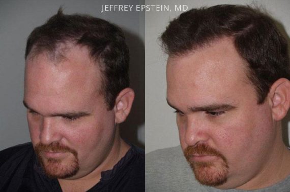 Trasplante de Pelo en Hombres Before and after in Miami, FL, Paciente 89785