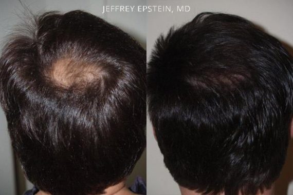 Trasplante de Pelo en Hombres Before and after in Miami, FL, Paciente 88917