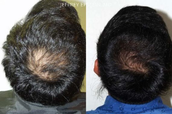 Trasplante de Pelo en Hombres Before and after in Miami, FL, Paciente 88185