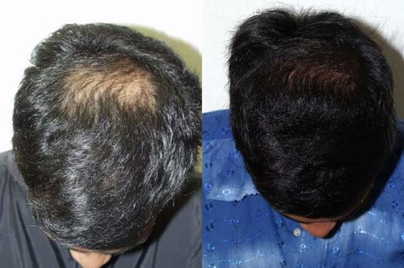 Trasplante de Pelo en Hombres Before and after in Miami, FL, Paciente 88185