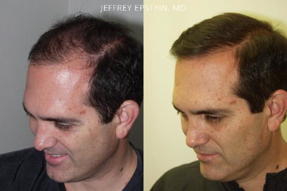 Trasplante de Pelo en Hombres Before and after in Miami, FL, Paciente 87479