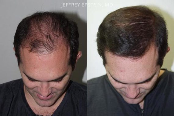 Trasplante de Pelo en Hombres Before and after in Miami, FL, Paciente 87479