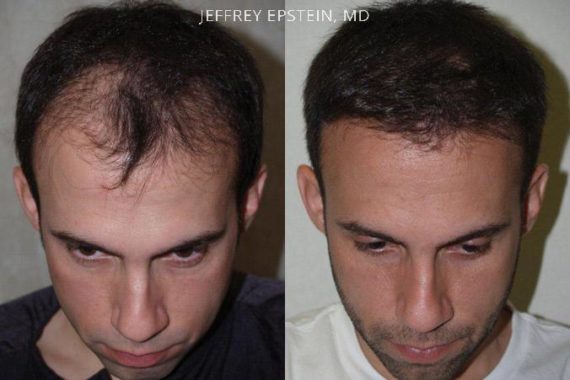 Trasplante de Pelo en Hombres Before and after in Miami, FL, Paciente 87448