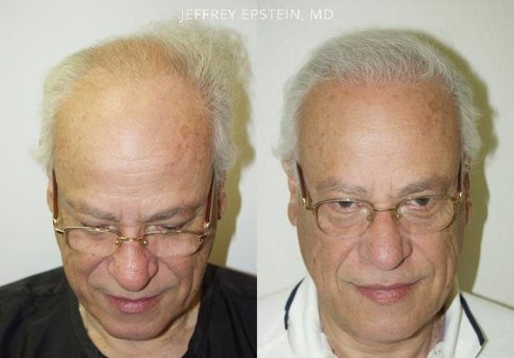 Trasplante de Pelo en Hombres Before and after in Miami, FL, Paciente 86476