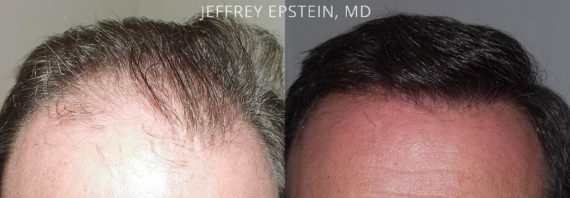 Trasplante de Pelo en Hombres Before and after in Miami, FL, Paciente 86096