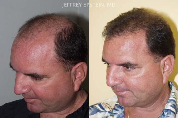 Trasplante de Pelo en Hombres Before and after in Miami, FL, Paciente 85701