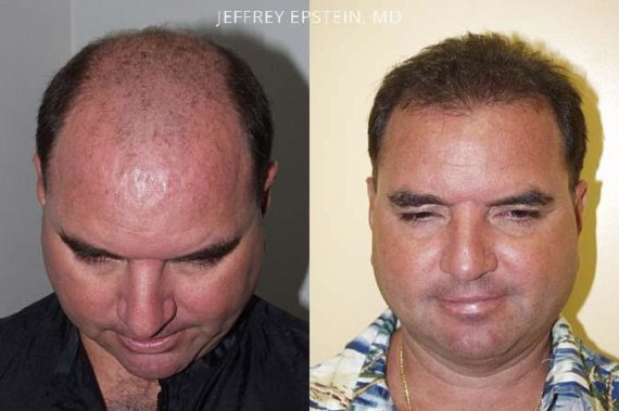 Trasplante de Pelo en Hombres Before and after in Miami, FL, Paciente 85701