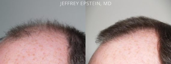 Trasplante de Pelo en Hombres Before and after in Miami, FL, Paciente 85350