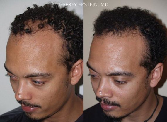 Trasplante de Pelo en Hombres Before and after in Miami, FL, Paciente 84962