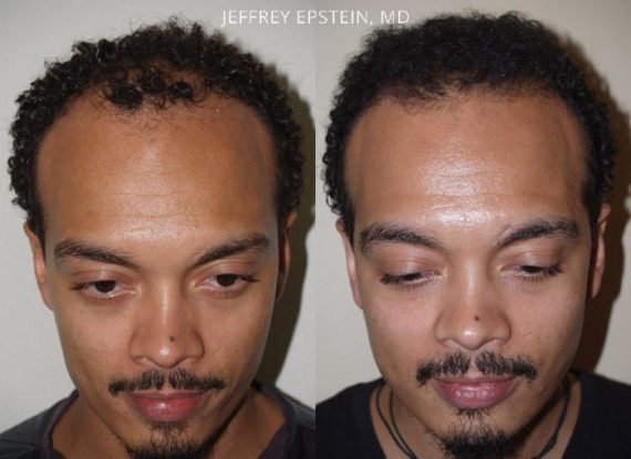 Trasplante de Pelo en Hombres Before and after in Miami, FL, Paciente 84962