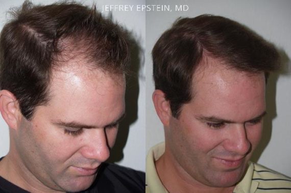 Trasplante de Pelo en Hombres Before and after in Miami, FL, Paciente 84676