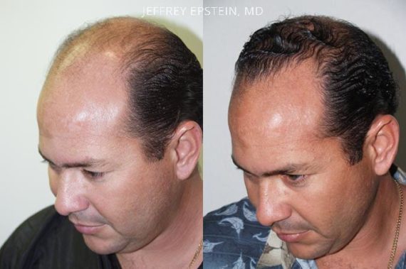 Trasplante de Pelo en Hombres Before and after in Miami, FL, Paciente 84581