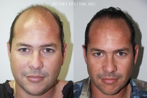 Trasplante de Pelo en Hombres Before and after in Miami, FL, Paciente 84581