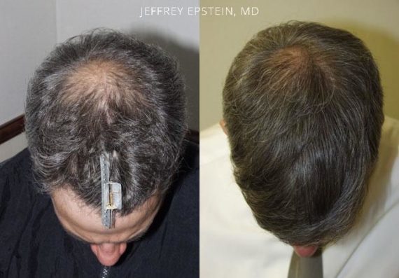 Trasplante de Pelo en Hombres Before and after in Miami, FL, Paciente 84122