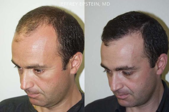 Trasplante de Pelo en Hombres Before and after in Miami, FL, Paciente 83972