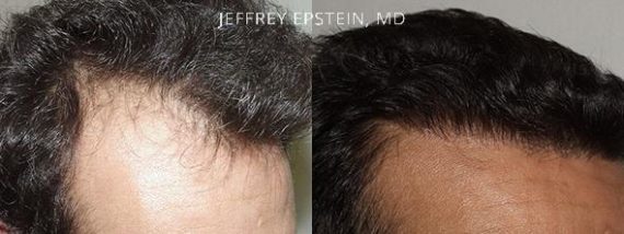 Trasplante de Pelo en Hombres Before and after in Miami, FL, Paciente 83848