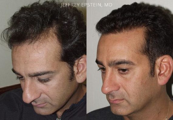 Trasplante de Pelo en Hombres Before and after in Miami, FL, Paciente 83848