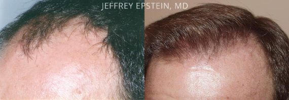 Trasplante de Pelo en Hombres Before and after in Miami, FL, Paciente 83823