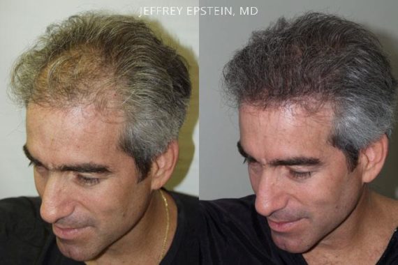 Trasplante de Pelo en Hombres Before and after in Miami, FL, Paciente 83680