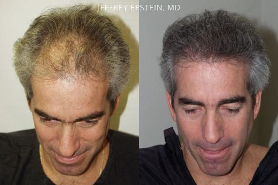 Trasplante de Pelo en Hombres Before and after in Miami, FL, Paciente 83680