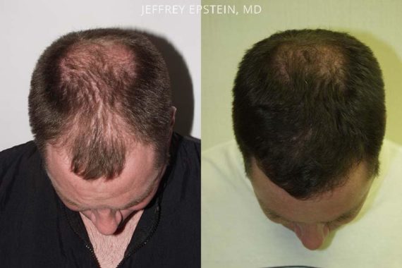 Trasplante de Pelo en Hombres Before and after in Miami, FL, Paciente 83254