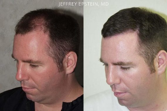 Trasplante de Pelo en Hombres Before and after in Miami, FL, Paciente 83254