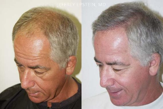 Trasplante de Pelo en Hombres Before and after in Miami, FL, Paciente 83219