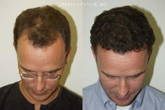 Trasplante de Pelo en Hombres Before and after in Miami, FL, Paciente 83197