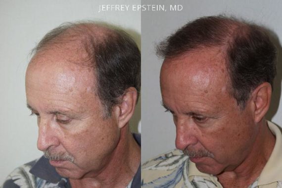 Trasplante de Pelo en Hombres Before and after in Miami, FL, Paciente 83121