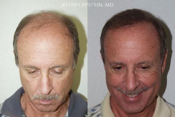 Trasplante de Pelo en Hombres Before and after in Miami, FL, Paciente 83121