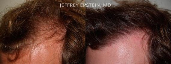 Trasplante de Pelo en Hombres Before and after in Miami, FL, Paciente 83039