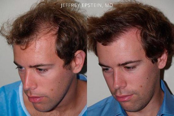 Trasplante de Pelo en Hombres Before and after in Miami, FL, Paciente 83039