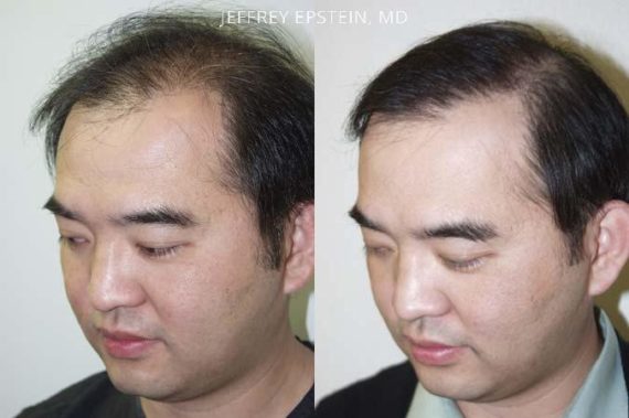 Trasplante de Pelo en Hombres Before and after in Miami, FL, Paciente 82785