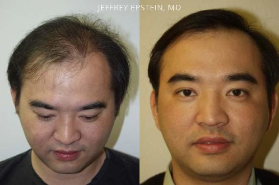 Trasplante de Pelo en Hombres Before and after in Miami, FL, Paciente 82785