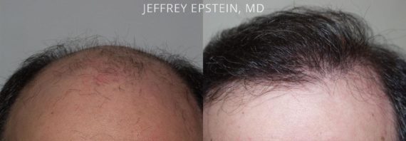 Trasplante de Pelo en Hombres Before and after in Miami, FL, Paciente 82754