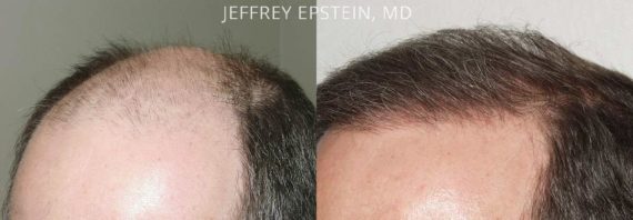 Trasplante de Pelo en Hombres Before and after in Miami, FL, Paciente 82604