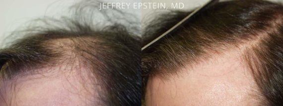 Trasplante de Pelo en Hombres Before and after in Miami, FL, Paciente 82460