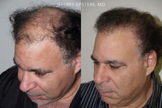 Trasplante de Pelo en Hombres Before and after in Miami, FL, Paciente 82204