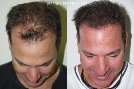 Trasplante de Pelo en Hombres Before and after in Miami, FL, Paciente 82068