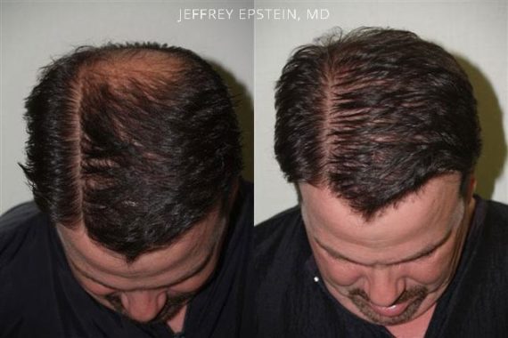 Trasplante de Pelo en Hombres Before and after in Miami, FL, Paciente 81873