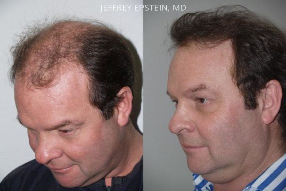 Trasplante de Pelo en Hombres Before and after in Miami, FL, Paciente 81739